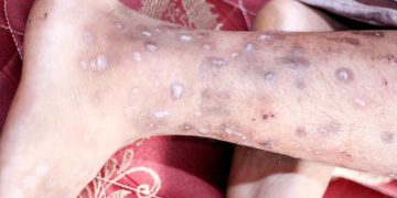 Haití advierte sobre una enfermedad similar a la sarna “altamente contagiosa”