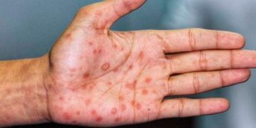 Salud Pública notifica un caso con síntomas de viruela del mono en la República Dominicana